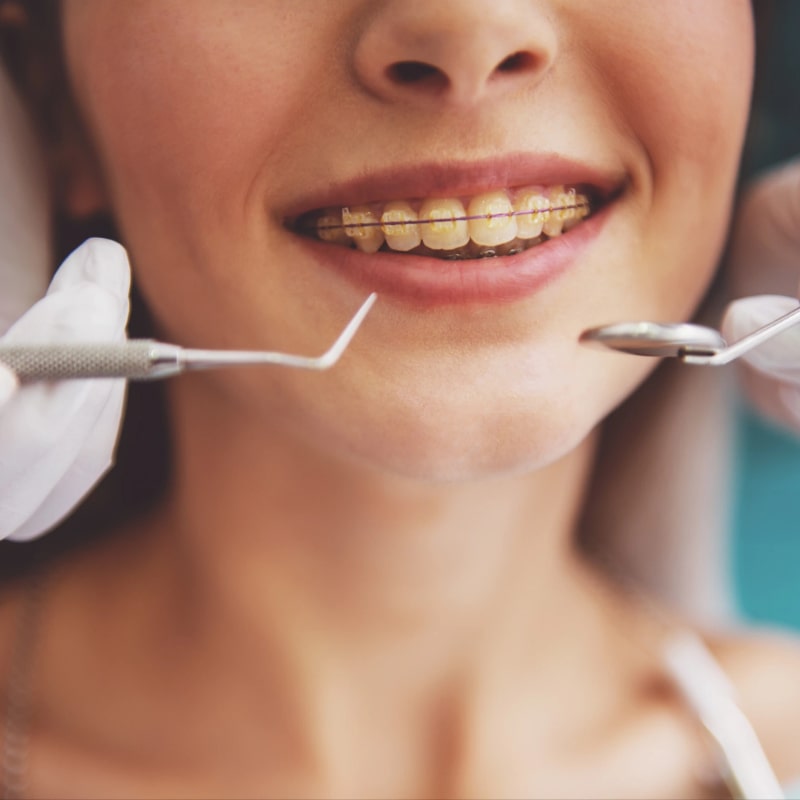Teeth and braces
